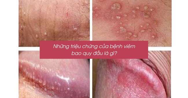 Những triệu chứng của viêm bao quy đầu ở nam giới
